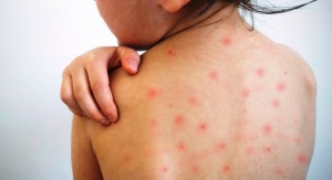 अमेरिकामा दादुराको प्रकोप        