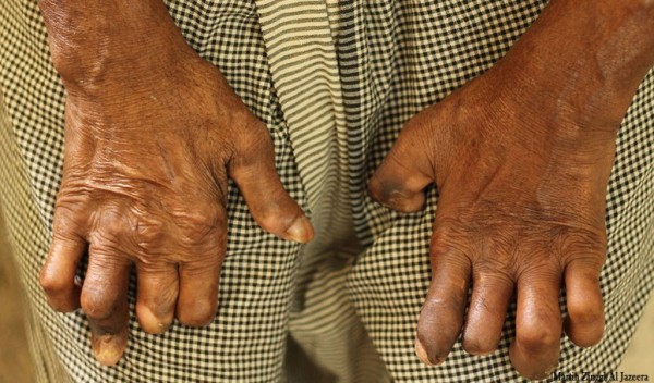 ७१औँ विश्व कुष्ठरोग दिवस मनाइँदै