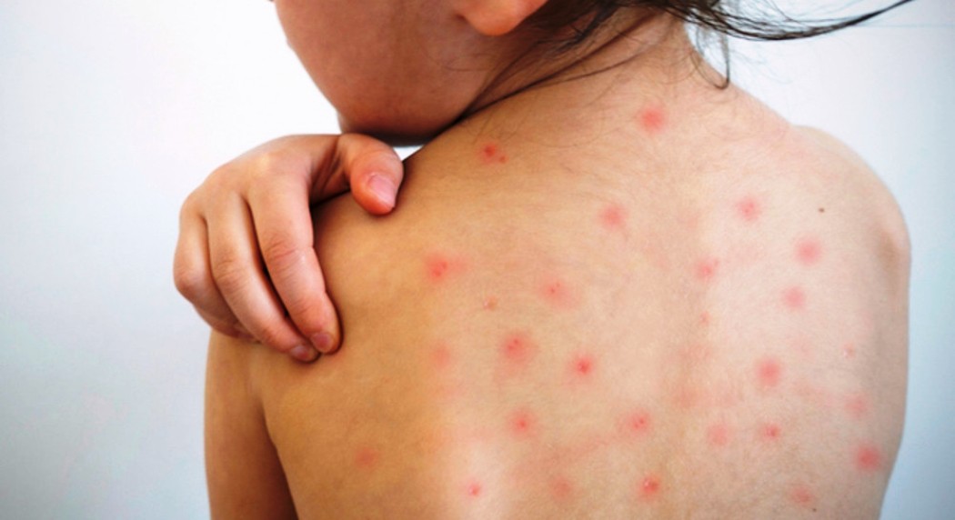 अमेरिकामा दादुराको प्रकोप        